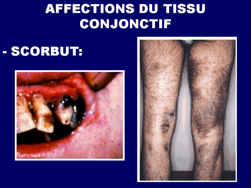 AFFECTIONS DU TISSU CONJONCTIF - SCORBUT: